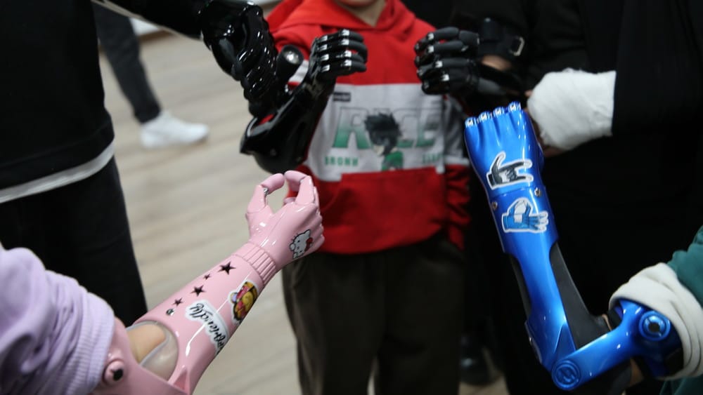 Өткөн жылы 11,5 миңдей кыргызстандыкка протездик-ортопедиялык кызмат көрсөтүлгөн